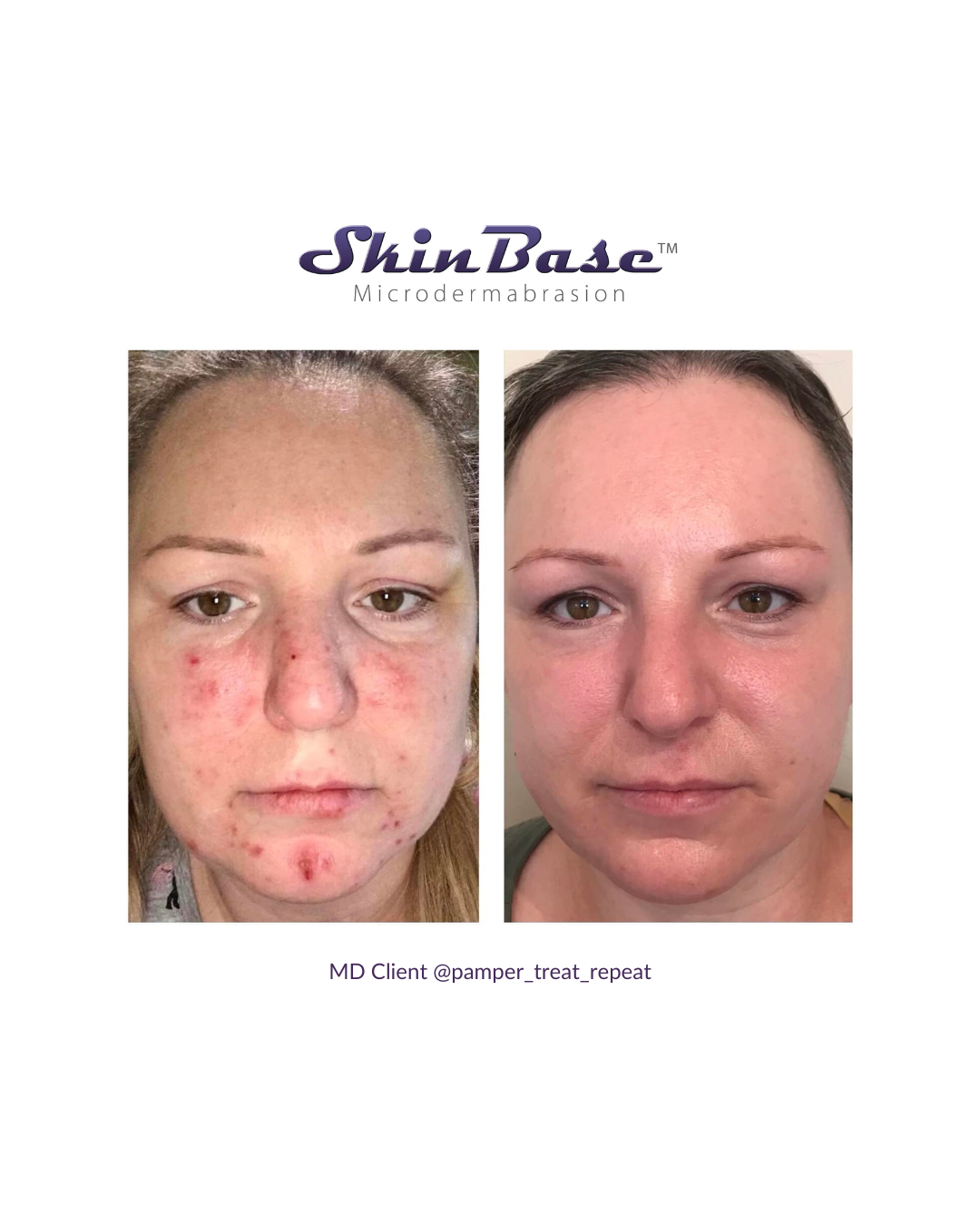 Acne Awareness Month Microdermabrasion Grid Post Series